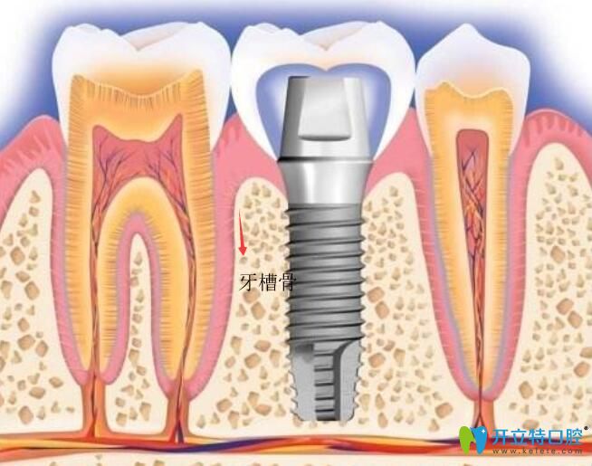 种植牙示意图
