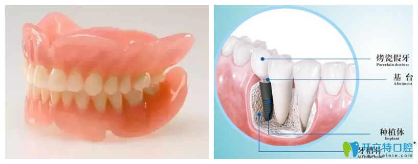 活动假牙和种植牙的图片对比