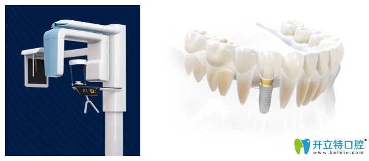 福州维乐口腔3D种植牙技术优势