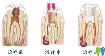 牙齿根管治疗步骤图