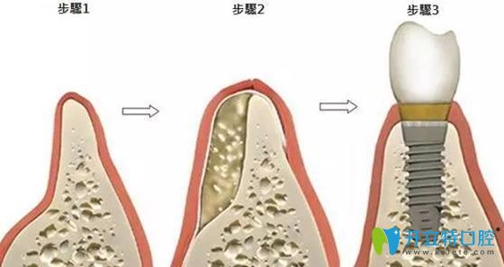 种牙植骨的步骤示意图