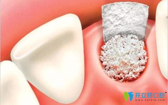 牙齿填入骨粉的利弊有哪些