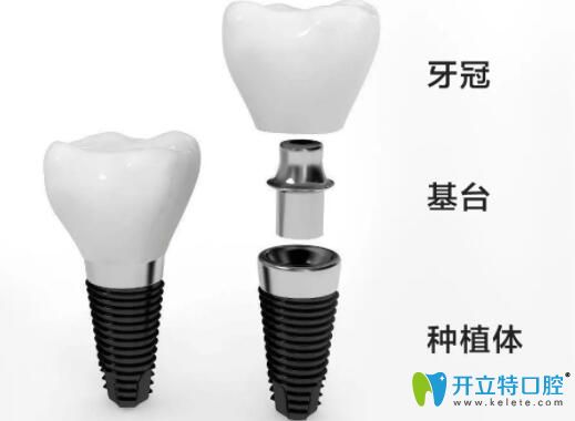 解析二段式种植体的组成及埋入式和非埋入式区别,种牙必看