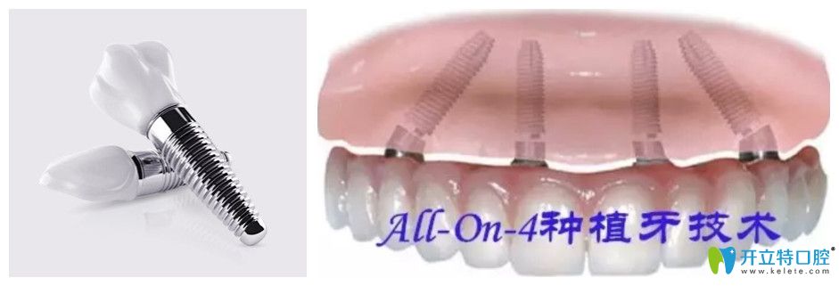 美奥口腔allon4半口牙种植价格图