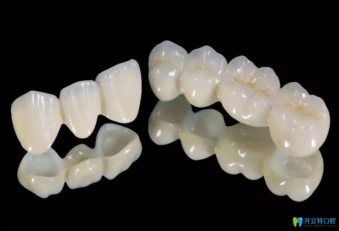 全瓷牙的图片
