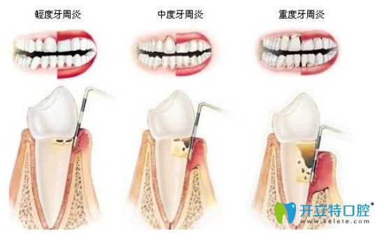 美奥口腔全口牙周治疗价格