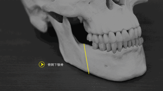 骨性龅牙矫正