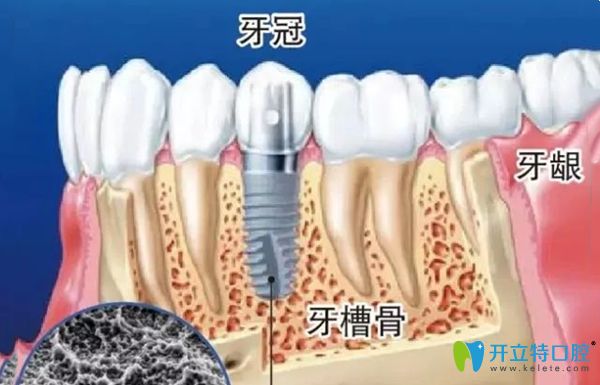 牙冠牙槽骨的相应位置