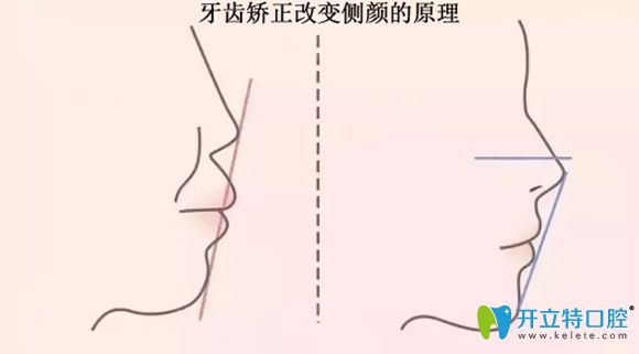牙齿矫正改善侧颜的原理图 牙齿矫正改善侧颜的原理图