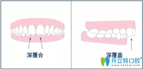 深覆合和深覆盖有什么区别