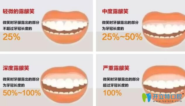 带牙套能治疗露龈笑吗?2个真实戴牙套改善露龈笑案例告诉你