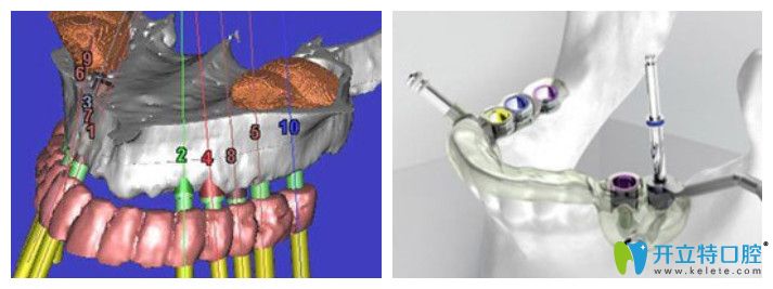 广大口腔的3d导板精准种植牙技术