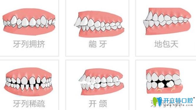 哪些牙齿问题可以做半隐形牙齿矫正