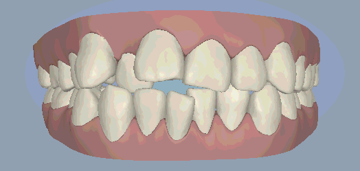 牙齿矫正牙齿移动图示