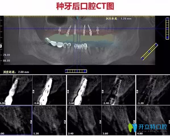 不了解珠海种牙哪家医院好不如看看仁爱口腔德国种植牙