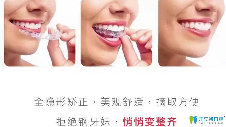 全隐形矫正距离美更进一步