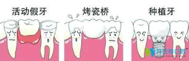 牙齿缺失可选择种植牙进行修复