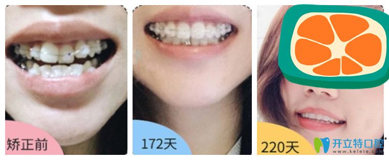 27岁牙齿不齐的小姐姐半隐形矫正前后对比图