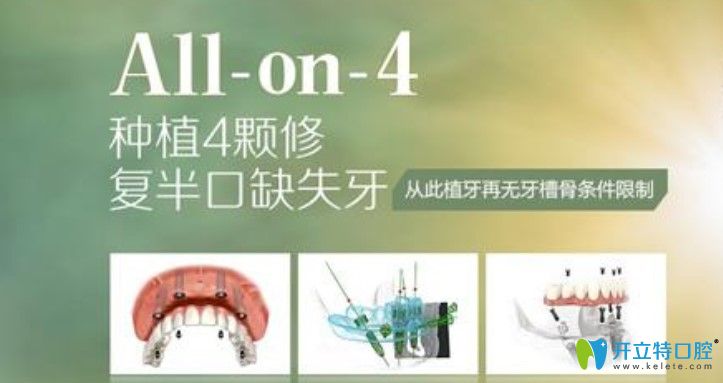 深圳龙华区拜尔口腔的allon4种植牙技术