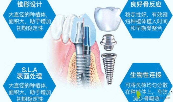 深圳龙华区种植牙一颗多少钱