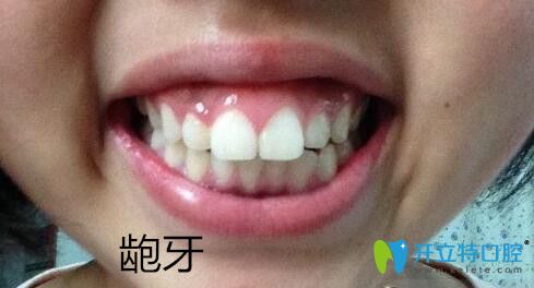 牙颌畸形之龅牙