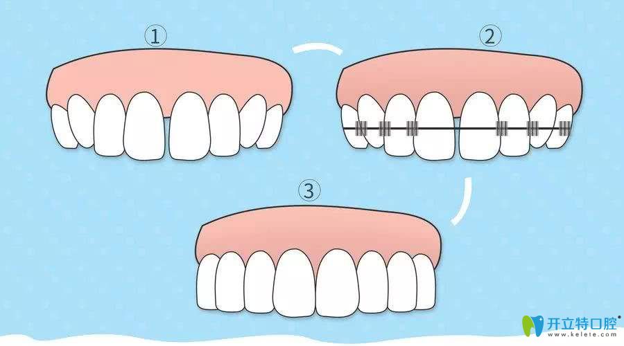 牙齿正畸中-传统自锁牙套和球面托槽自锁矫正的价格及区别