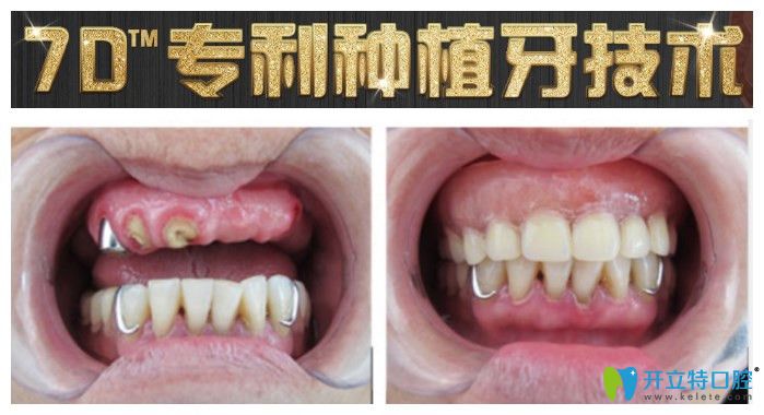 重庆团圆口腔半口种植牙 重庆团圆口腔半口种植牙