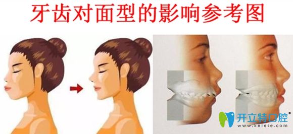 牙齿不齐对面型的影响图 牙齿不齐对面型的影响图