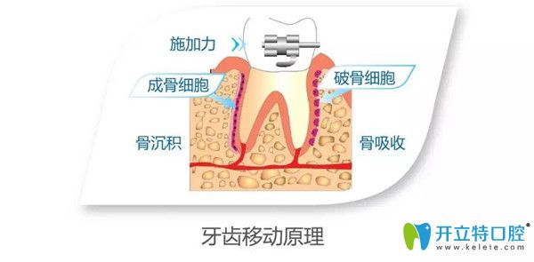 正畸加速器的牙齿移动原理