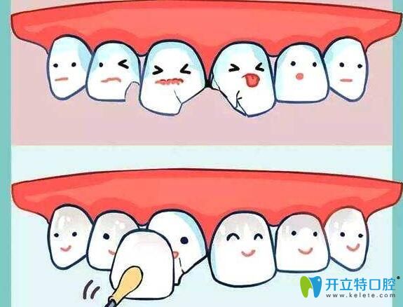 全瓷贴面贴住缺损牙