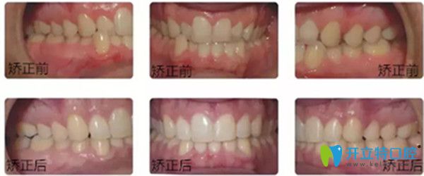 美速达正畸加速器效果前后对比