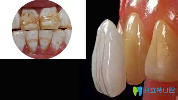 牙齿颜色或形态不好看，可用牙齿贴面或全瓷冠修复