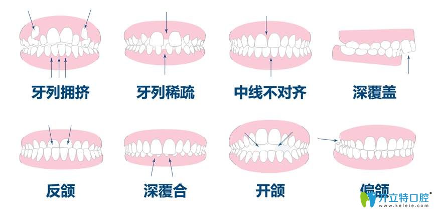 各类牙齿畸形情况