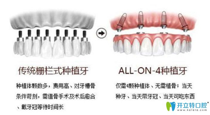 浩海口腔allon4种植牙优势有哪些