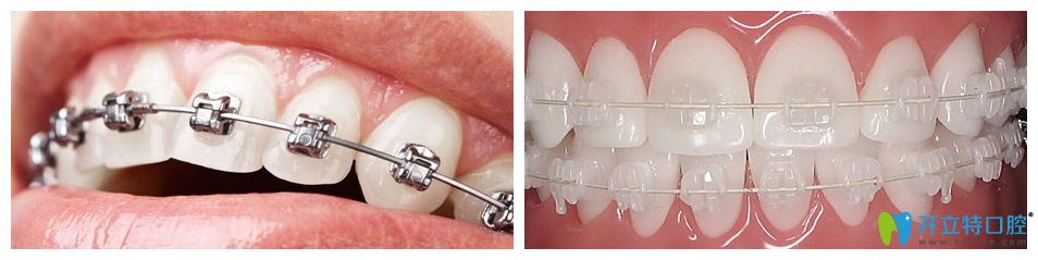 金属托槽矫正和陶瓷托槽矫正 金属托槽矫正和陶瓷托槽矫正