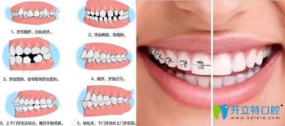 牙齿矫正技术可以改善多种牙齿不齐问题