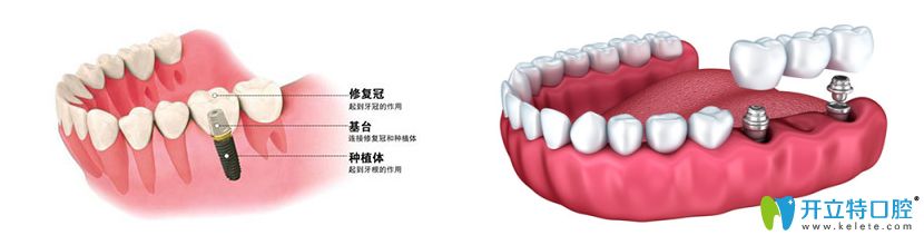 种植牙介绍图 种植牙介绍图