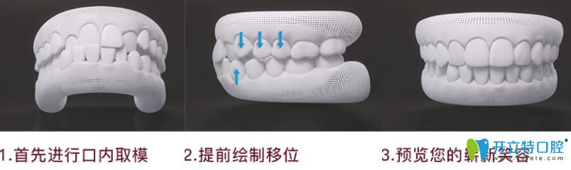 深圳珮斐齿科隐适美隐形矫正流程图