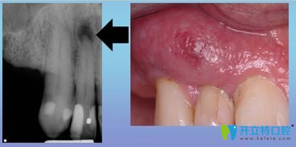 口腔牙龈瘘管的治疗价格会因病情轻重而不同