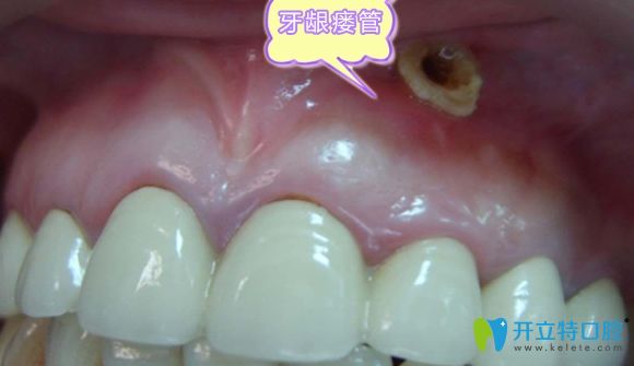 牙龈瘘管症状示意图
