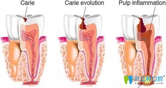 牙龈瘘管的形成过程