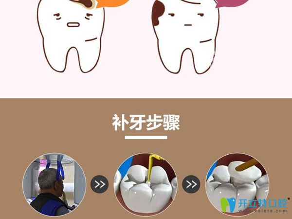 牙医解析补牙用什么材料好，选卡瑞斯玛树脂补牙还是3m好？