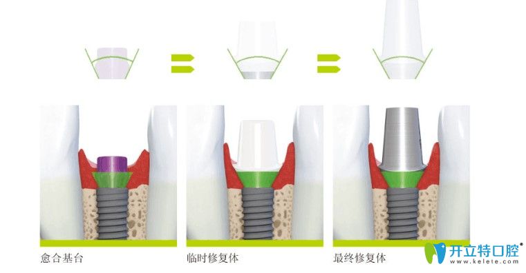 什么是骨水平种植体