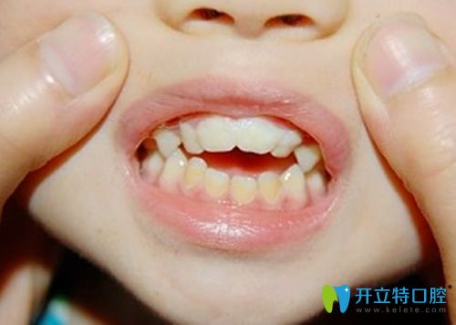 错位咬合图 错位咬合图