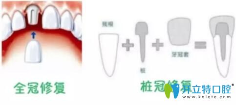 全瓷冠修复 全瓷冠修复