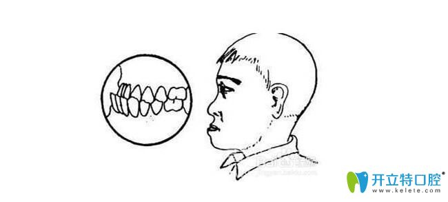 前牙反颌图 前牙反颌图