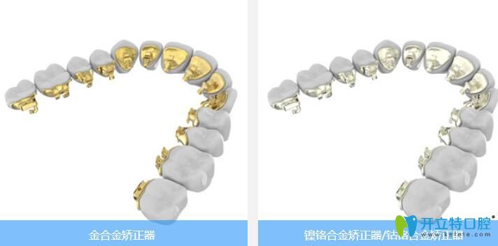 ebrace舌侧牙套材质 ebrace舌侧牙套材质