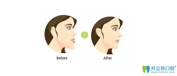 双颌前突图 双颌前突图