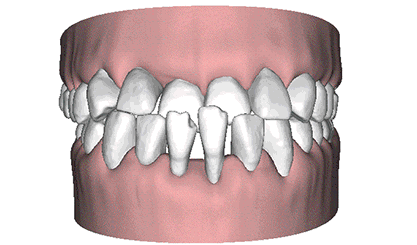 前牙深覆盖动画图解 前牙深覆盖动画图解