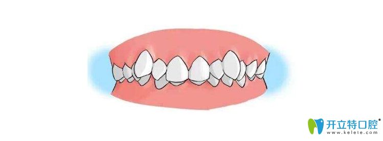牙列拥挤图 牙列拥挤图